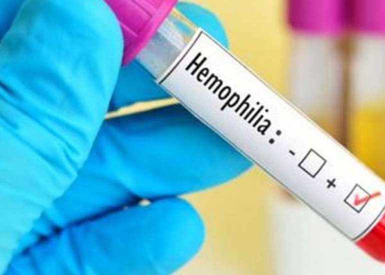 हीमोफीलिया ए क्या है? कारण, लक्षण और इलाज
