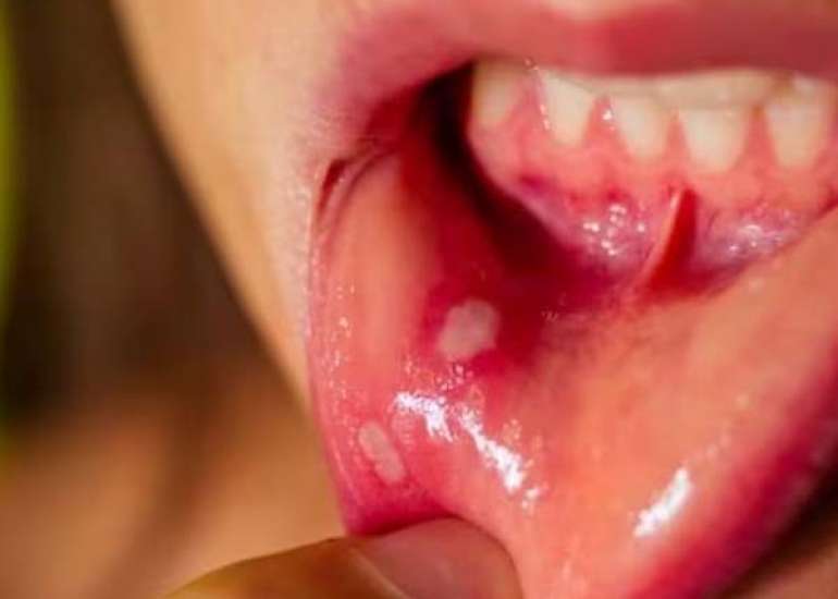 मुँह के कैंसर की जांच – विस्तार से जाने | Oral Cancer Screening – Know in Detail