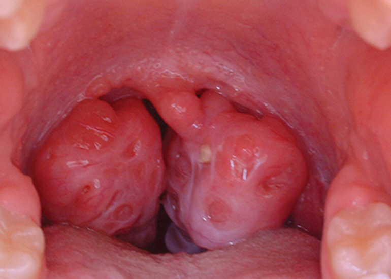 Factors influencing post-operative growth in pre-pubertal children after adenotonsillectomy