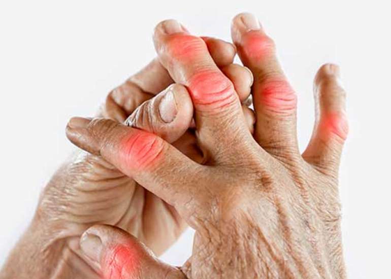 Arthritis: A Common Joint Disorder
