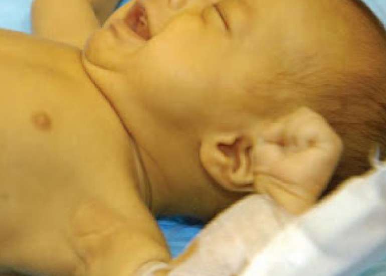 Assessment, management, and incidence of neonatal jaundice in healthy neonates cared for in primary care