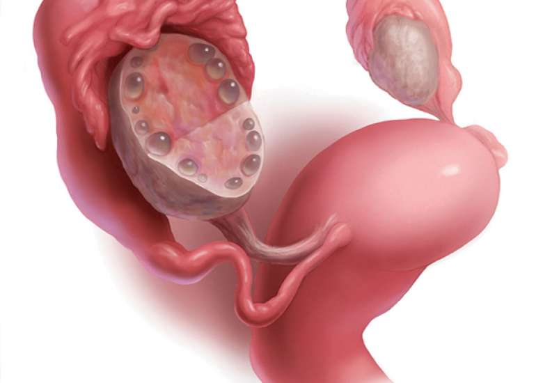 Astaxanthin treatment alleviates ER stress in patients with polycystic ovary syndrome