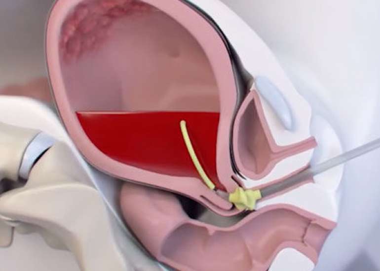 Atonic Postpartum Hemorrhage: Risk factors