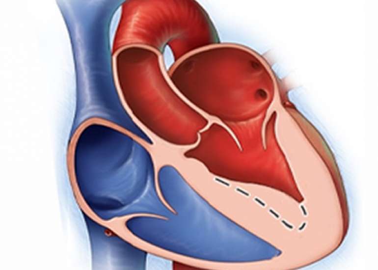 Atrial Septal Defect Treatment & Management | ASD 
