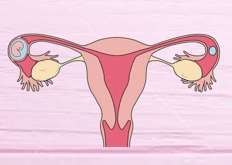 Atypical Ectopic Pregnancy