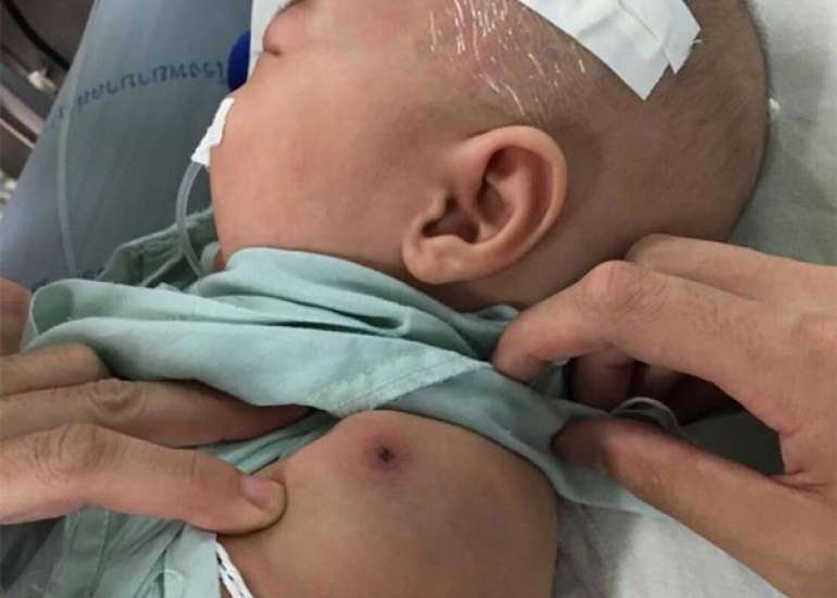 Atypical Kawasaki disease with polymyositis and panniculitis