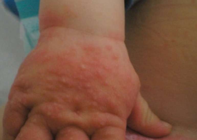 Autoeczematization Id reaction following candidal diaper dermatitis