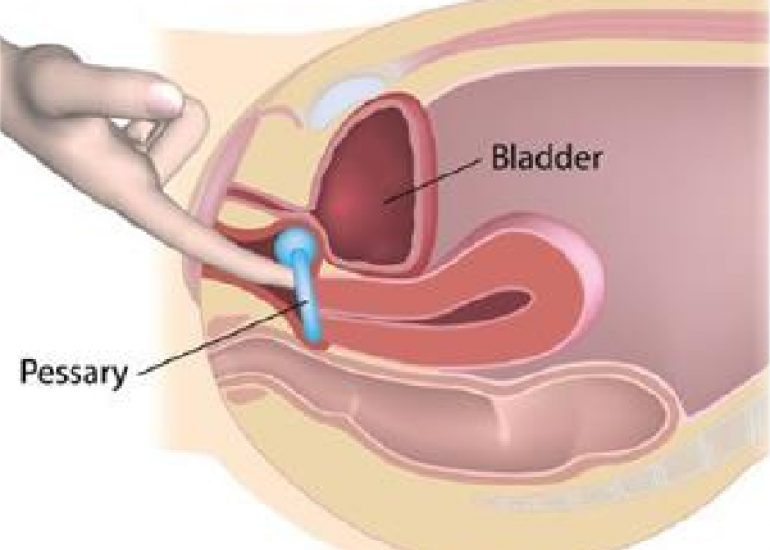 पेसरी क्या है? | Pessary in Hindi