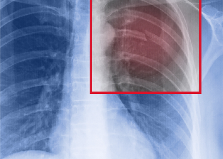 रिब फ्रैक्चर क्या है? कारण, लक्षण और इलाज | Rib Fracture in Hindi