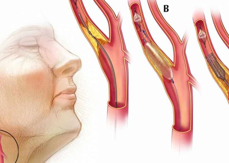 Can bypass be done along with carotid artery intervention?