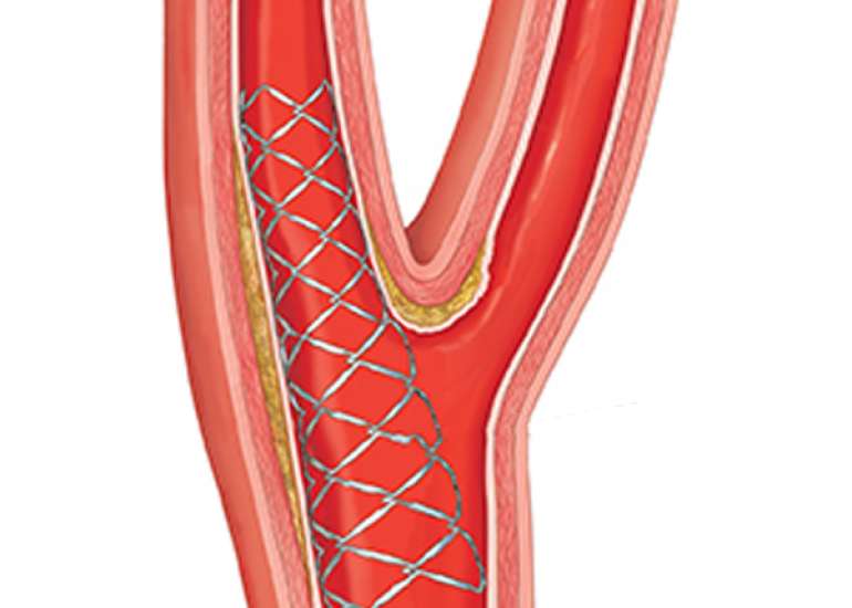 Can primary PCI be done along with carotid angioplasty?