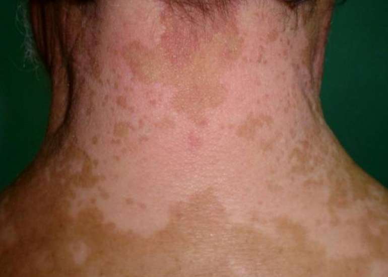 Can Vitiligo go for a remission?