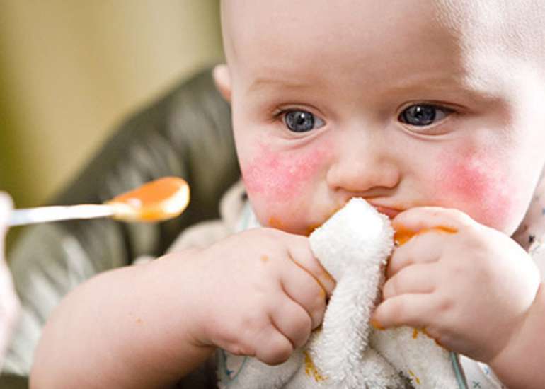 Can a food allergy also cause a blocked or runny nose in my child?
