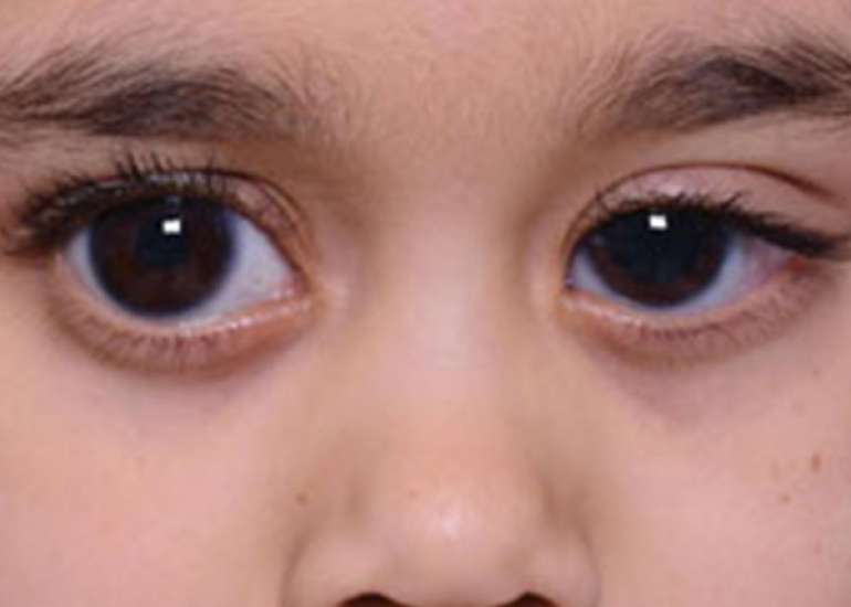 Can glaucoma occur in children?