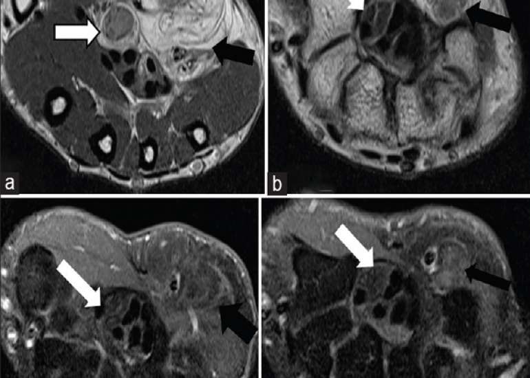 Case of fibrolipomatous hamartoma
