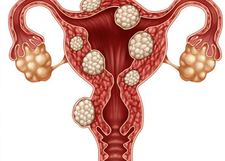 Case of a Vulvar Leiomyoma