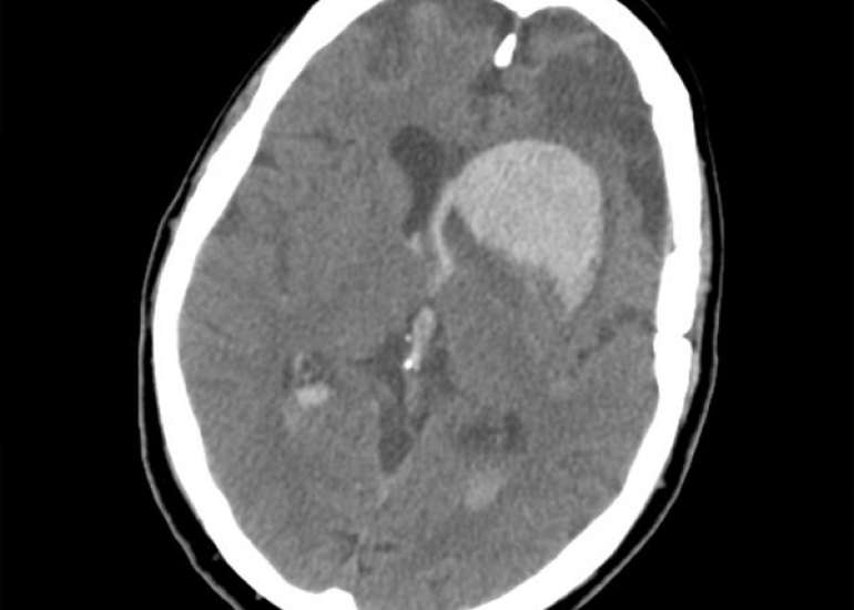 Cerebral aneurysms in pediatrics