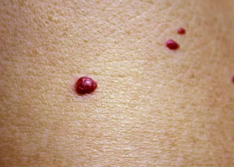 चेरी एंजियोमा क्या है? कारण, लक्षण और इलाज | Cherry Angioma in Hindi