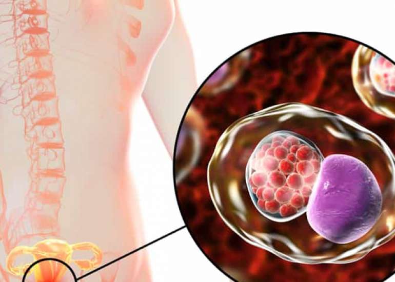 क्लैमाइडिया क्या है? कारण, लक्षण और इलाज | Chlamydia in Hindi