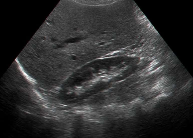 Choosing the Right Age Group for Ultrasonography Screening After Initial Childhood Urinary Tract Infection