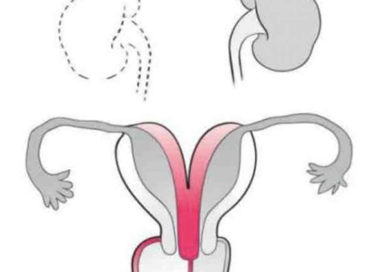 Clear Cell Carcinoma of the Cervix with OHVIRA Syndrome: A Rare Case Report