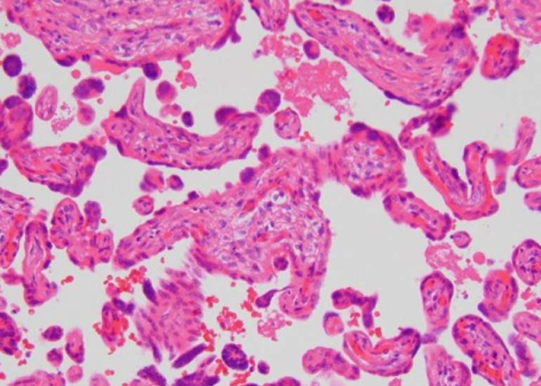 Clinical correlates of histopathological entities of the placenta