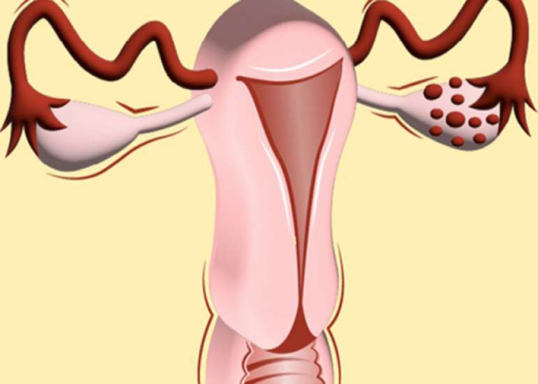Clomiphene citrate plus metformin Vs. Clomiphene citrate alone for induction of ovulation in women with polycystic ovarian syndrome.