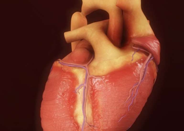Coarctation of the aorta in children?
