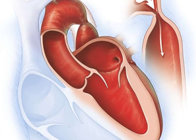 How should we diagnose coarctation of aorta?