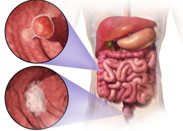Colon Cancer status in India