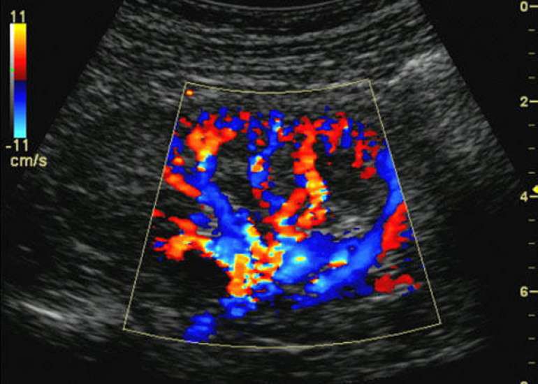 Color Doppler in high-risk pregnancies