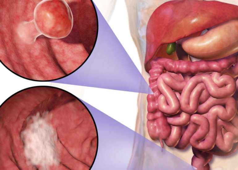 कोलोरेक्टल कैंसर - कोलोरेक्टल कैंसर क्यों होता है, लक्षण, उपचार, दवा