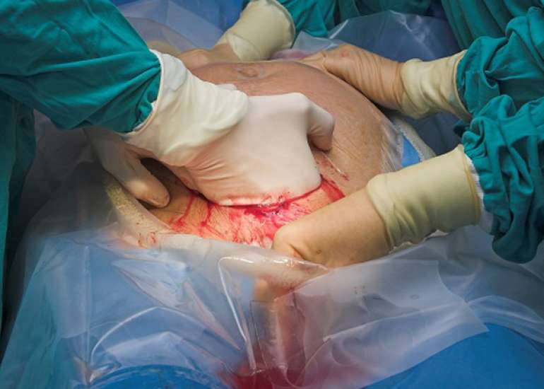 Comparing acute pain management strategies following C-section