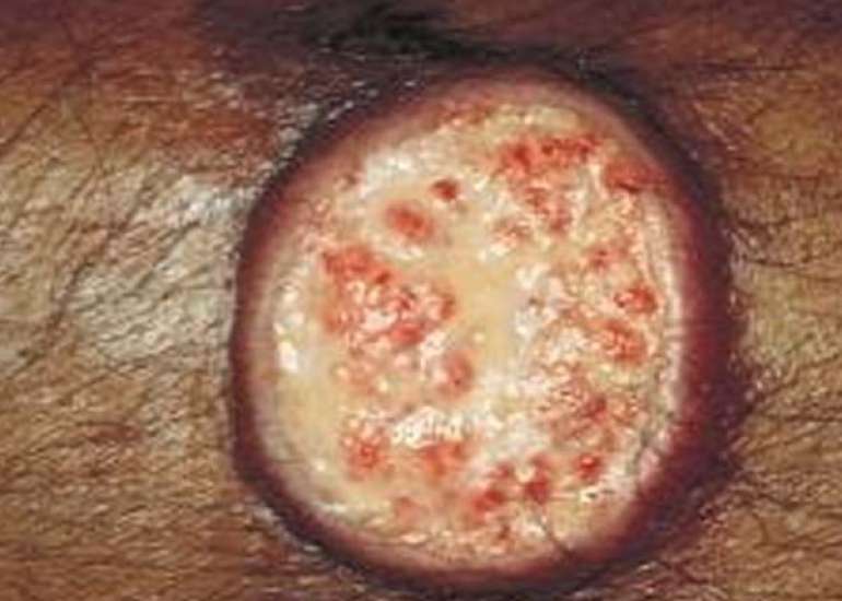 Complex Cutaneous Leishmaniasis in Pregnancy