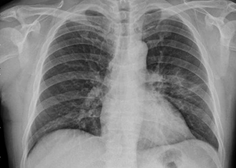 Complicated Acute Pericarditis Caused by Methicillin-Resistant Staphylococcus aureus after Influenza B Virus Infection: A Case Report