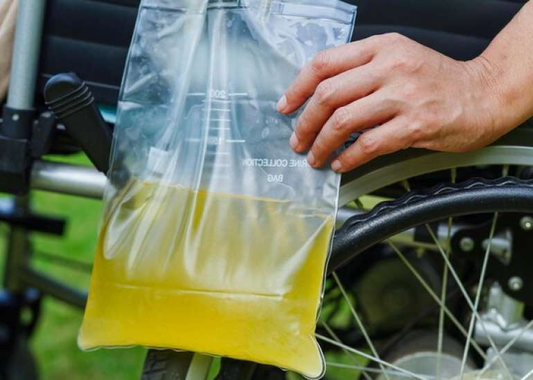 कंडोम कैथेटर क्या है?| Condom Catheter in Hindi