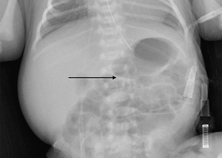 Congenital Duodenal Obstruction Presenting as an Olive-Shaped Abdominal Mass: Case Study