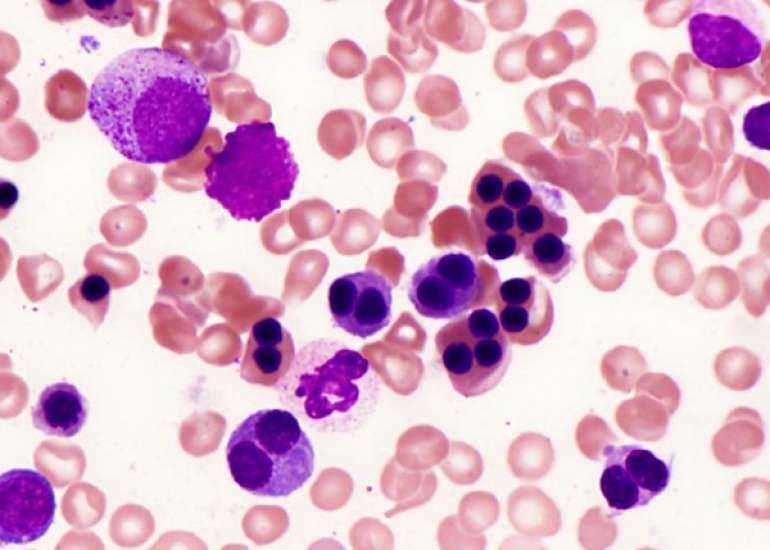 Congenital Dyserythropoietic Anemia Type 1