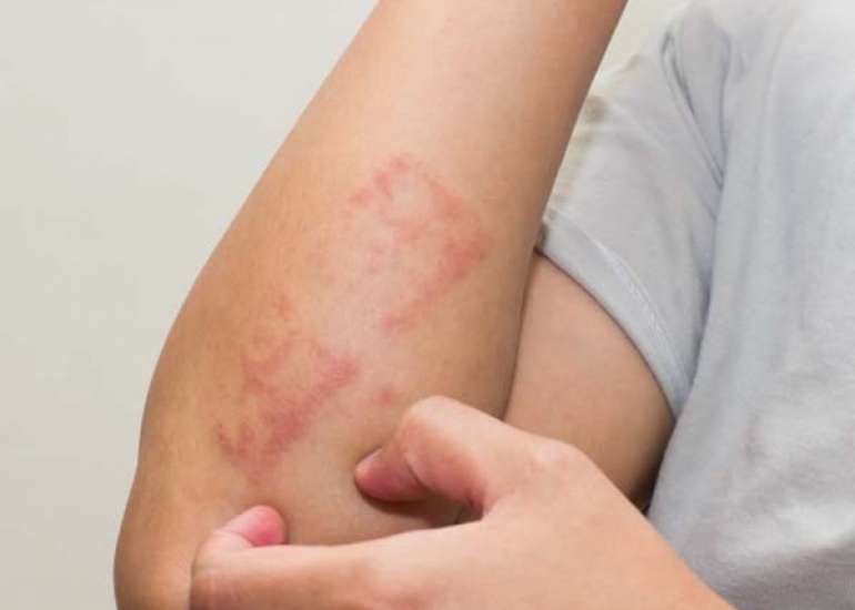 Contact Dermatitis to a Topical Antibiotic after Skin Injury