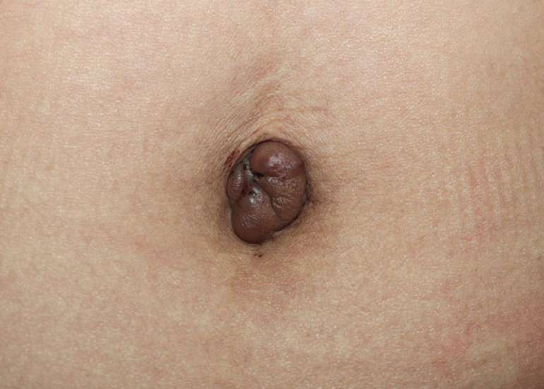 Cutaneous Endometriosis: A Case Report