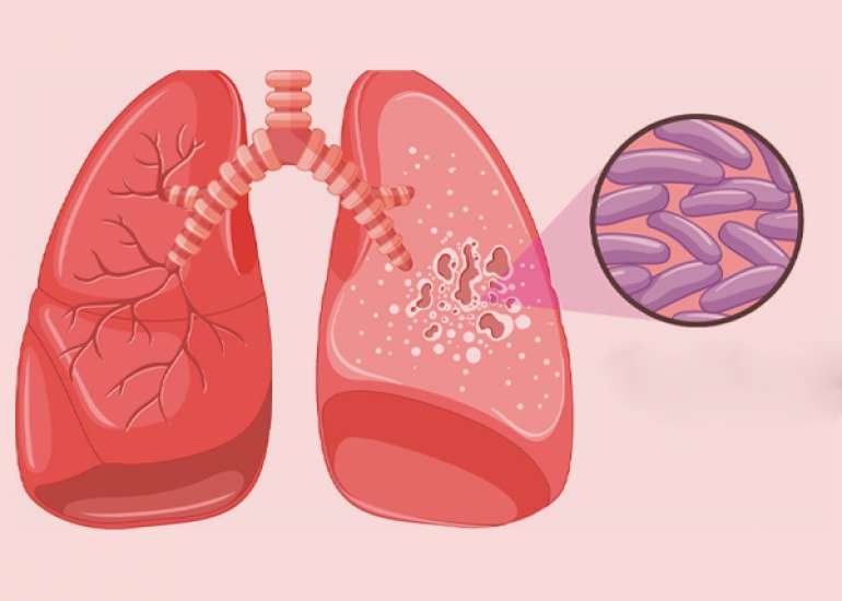 DILI From Antitubercular Treatment