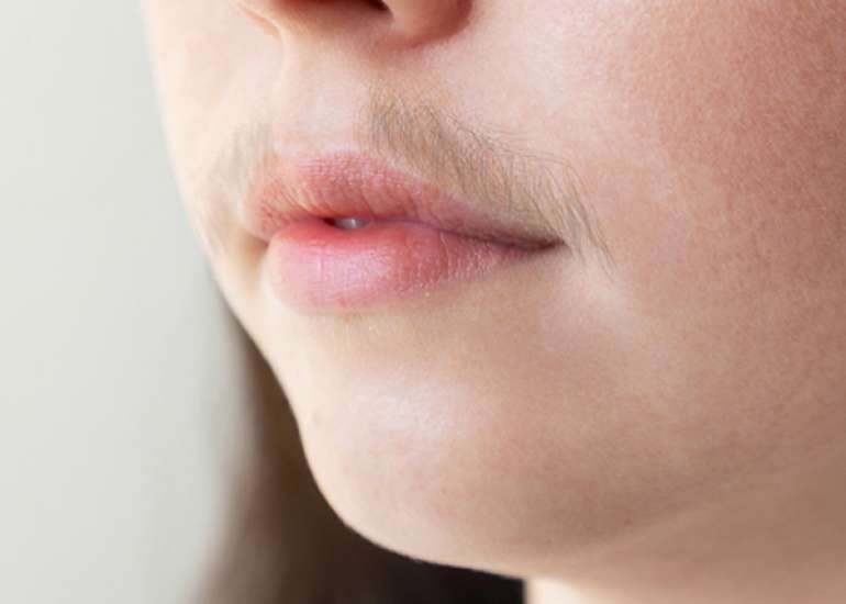 Deducing factors that precipitate Idiopathic hirsutism