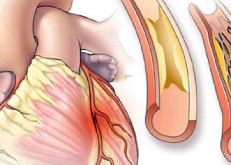 Definition of stable angina?