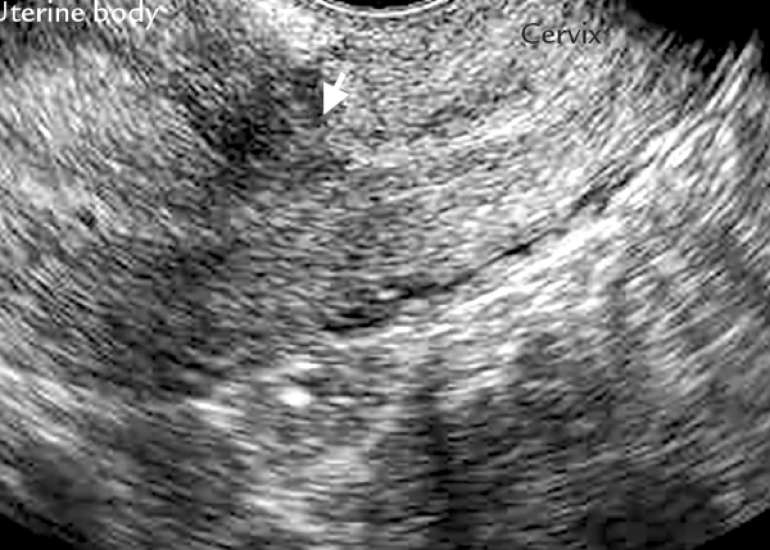 Definition and sonographic reporting system for Cesarean scar pregnancy in early gestation: modified Delphi method