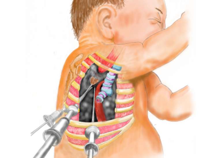 Descending necrotizing mediastinitis with severe thoracic empyema managed using minimally invasive video-assisted thoracoscopic surgery