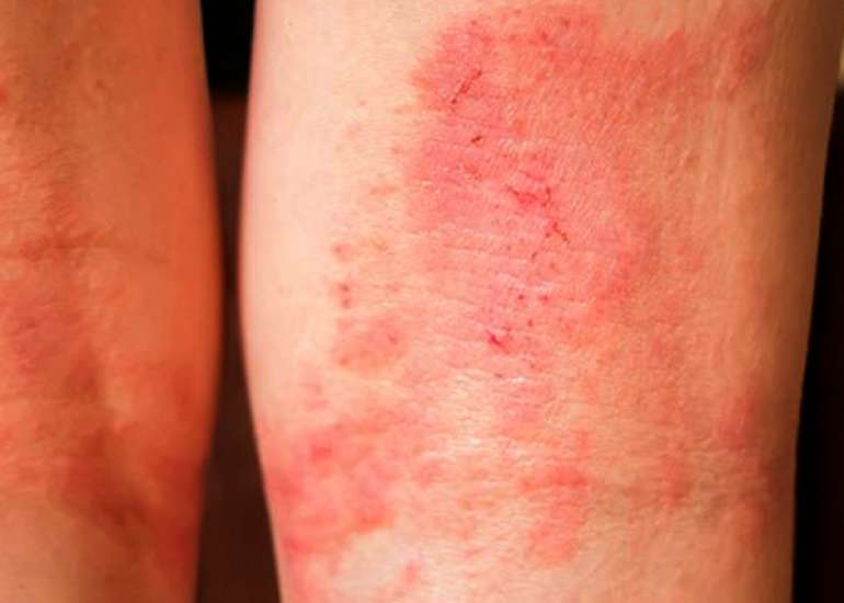 Dexpanthenol for Atopic Dermatitis