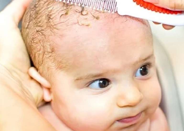 Diagnosis and Management of Seborrheic Dermatitis