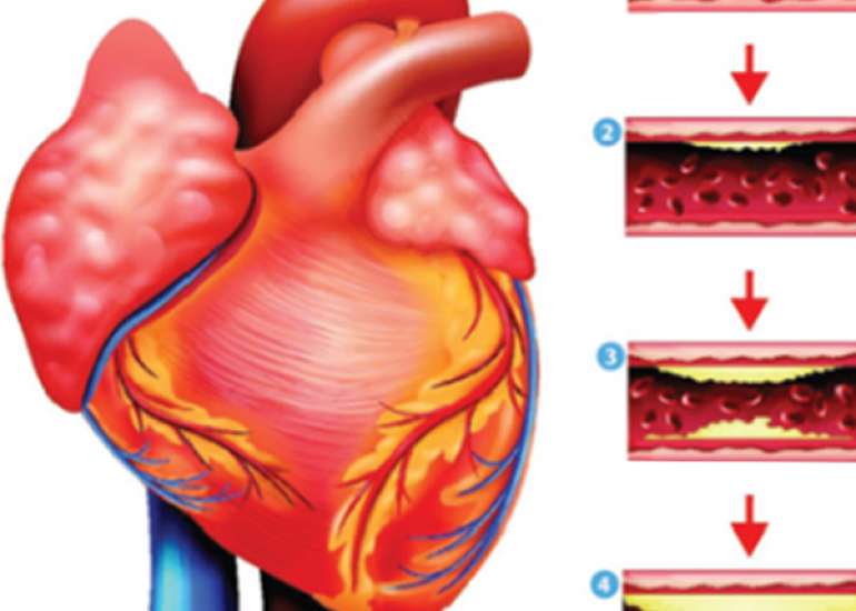 Differentiate progressive and non-progressive coronary artery disease?