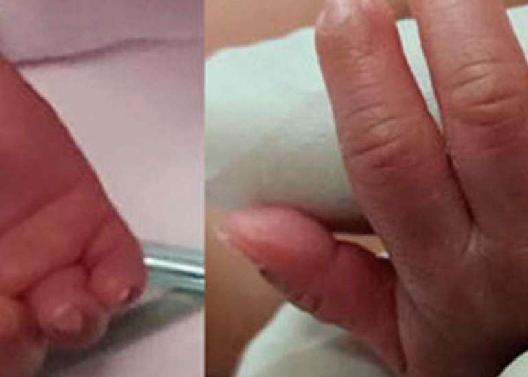 Digital Ischemia in an Extreme Preterm Infant Treated with Nitroglycerin Patch