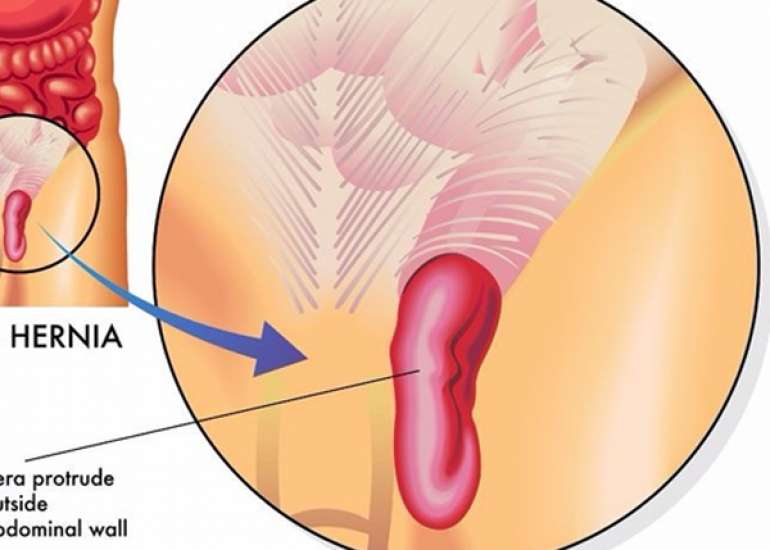 Discuss hernia and its management?